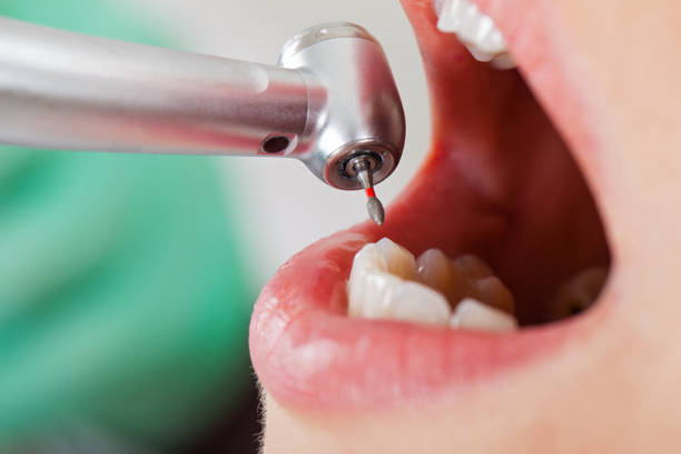 Best Emergency Wisdom Teeth Removal in Williamsport, MD